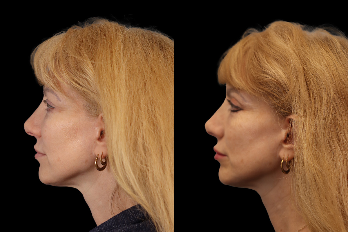 Blepharoplasty Before & After Gallery - Patient 964435 - Image 6