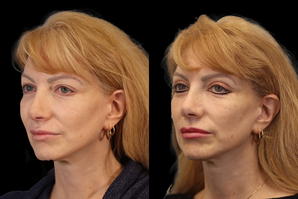 Blepharoplasty Before & After Gallery - Patient 964435 - Image 5
