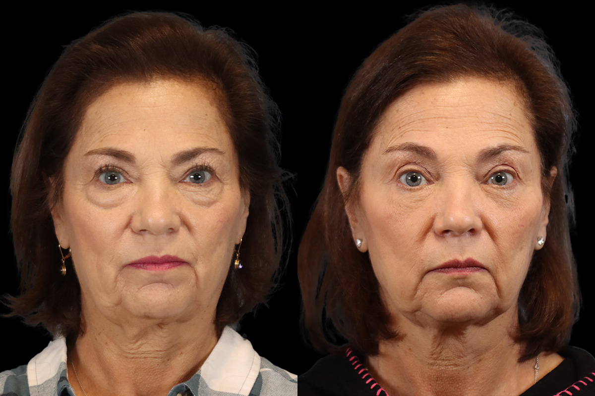Blepharoplasty Before & After Gallery - Patient 770136 - Image 1