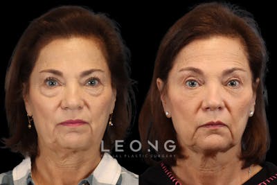 Eyes Before & After Gallery - Patient 118349 - Image 1