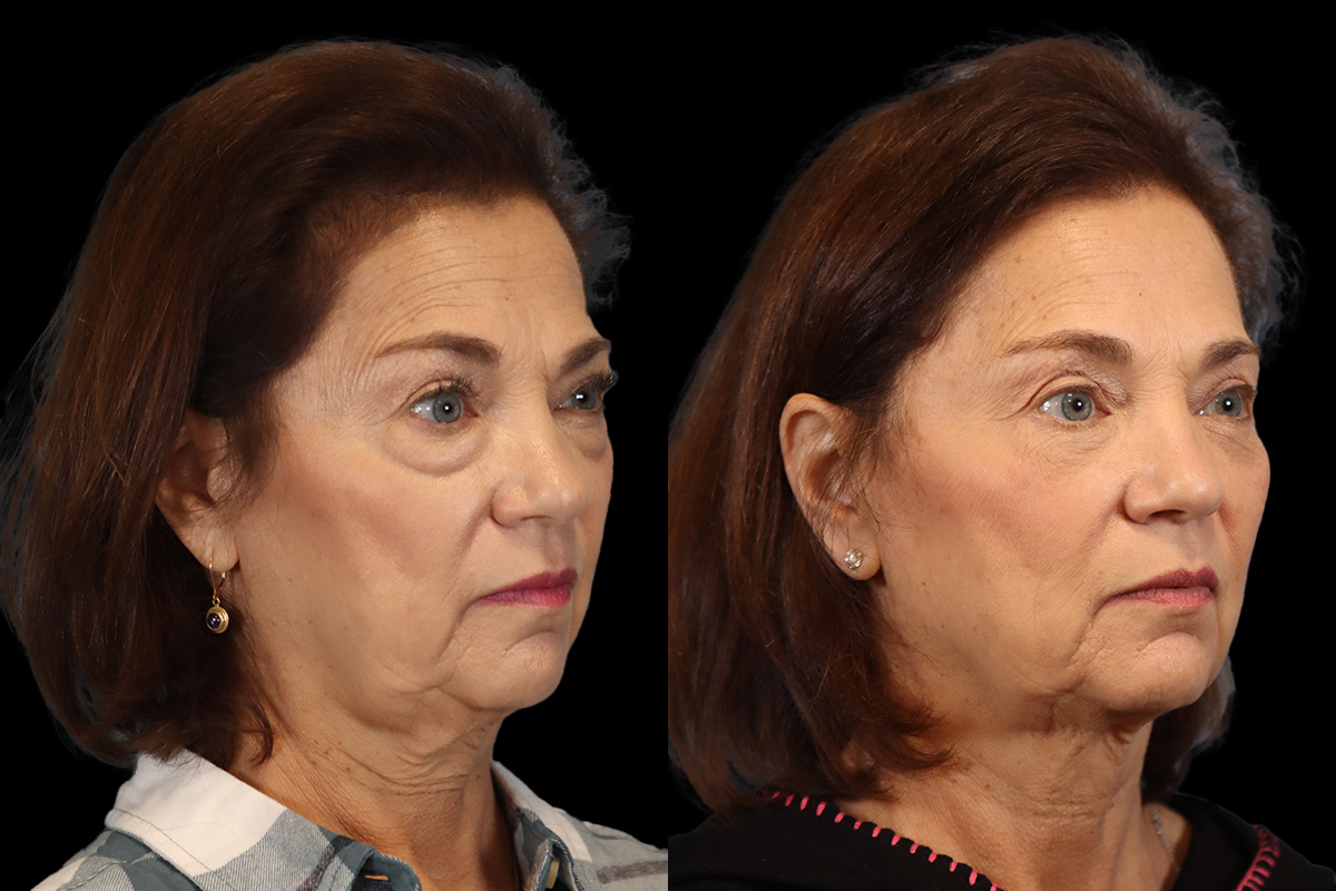 Blepharoplasty Before & After Gallery - Patient 770136 - Image 2