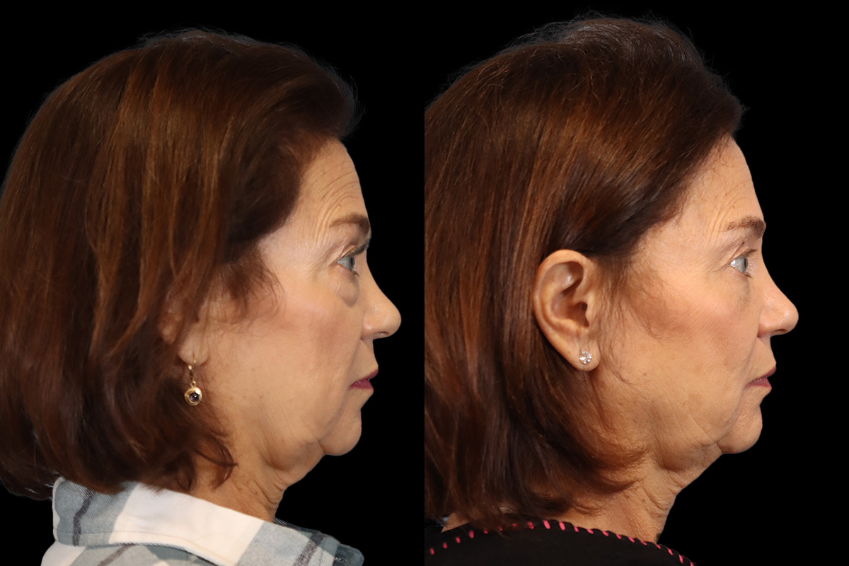 Blepharoplasty Before & After Gallery - Patient 770136 - Image 3