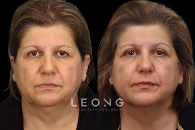 Eyes Before & After Gallery - Patient 406596 - Image 1