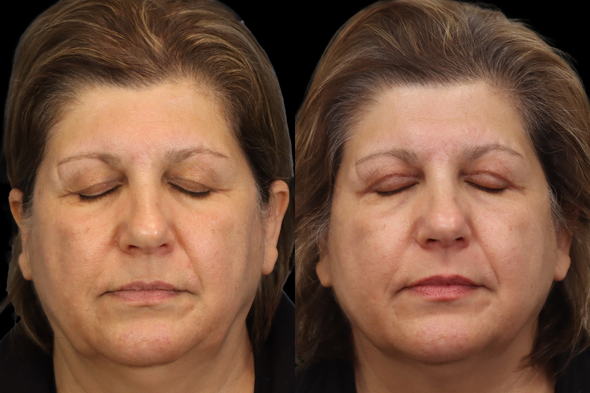 Blepharoplasty Before & After Gallery - Patient 631262 - Image 3