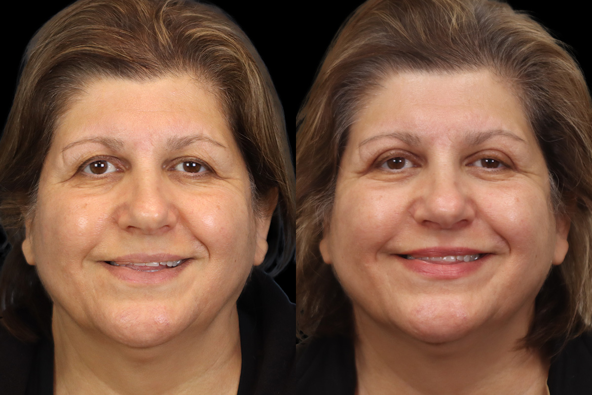 Blepharoplasty Before & After Gallery - Patient 631262 - Image 2