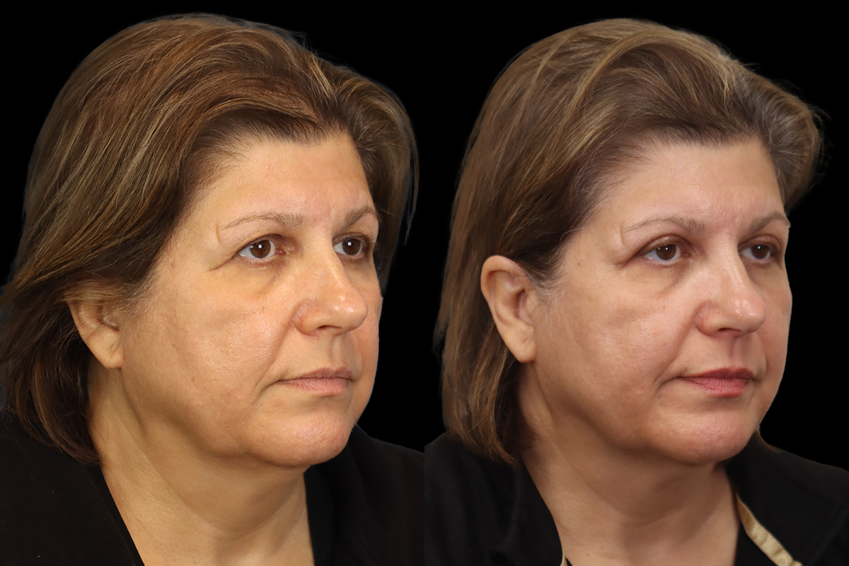 Blepharoplasty Before & After Gallery - Patient 631262 - Image 4