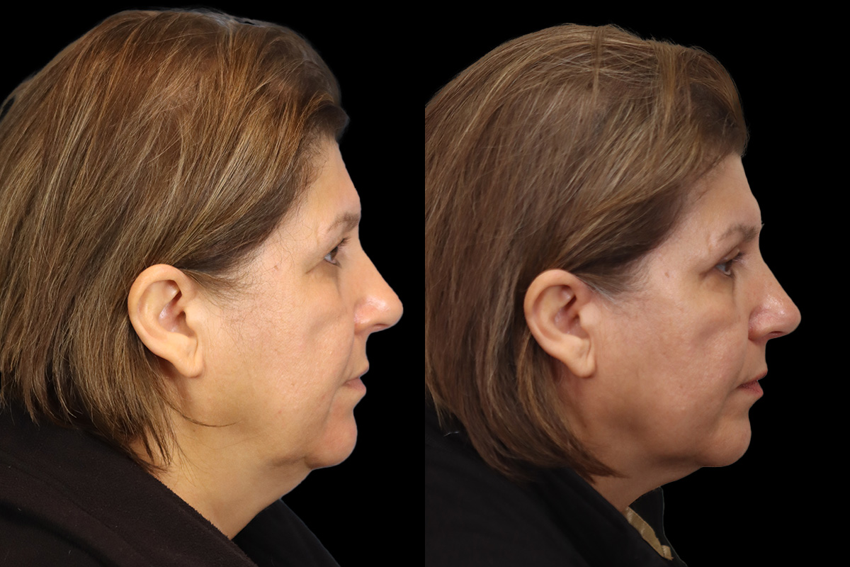 Blepharoplasty Before & After Gallery - Patient 631262 - Image 5