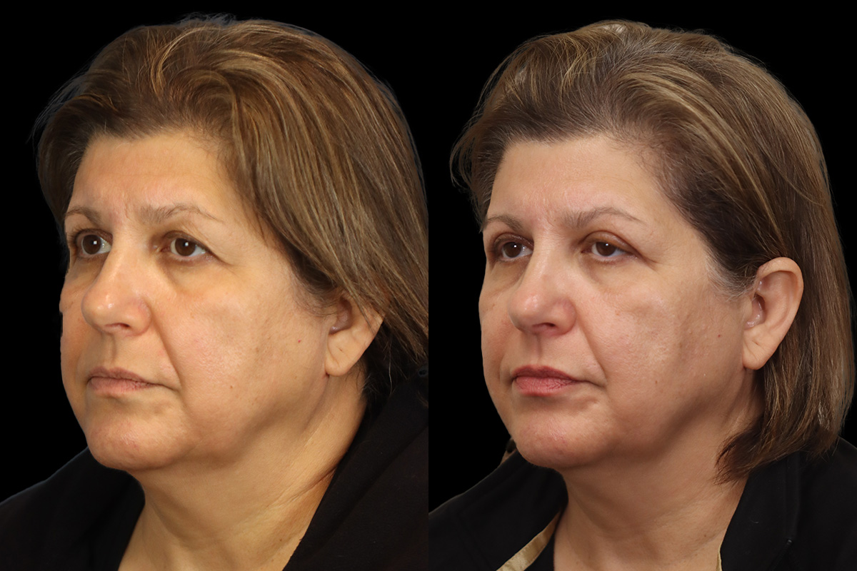 Blepharoplasty Before & After Gallery - Patient 631262 - Image 6