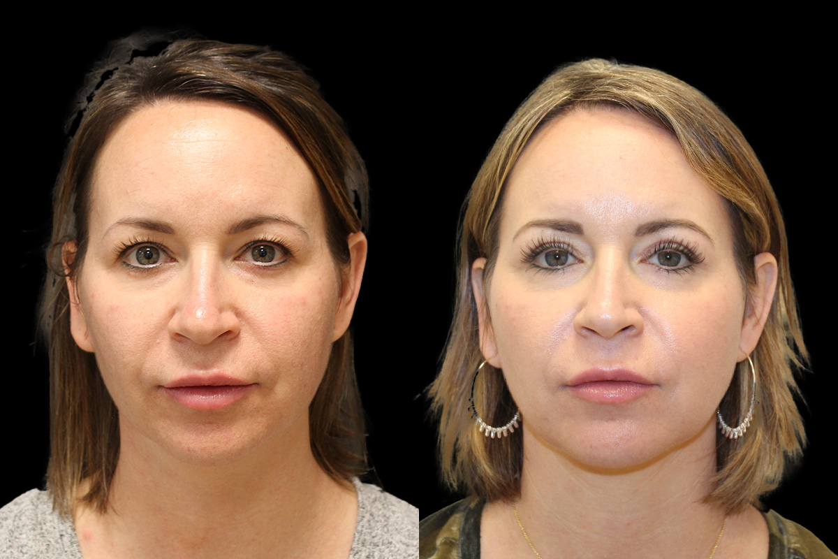 Blepharoplasty Before & After Gallery - Patient 371351 - Image 1