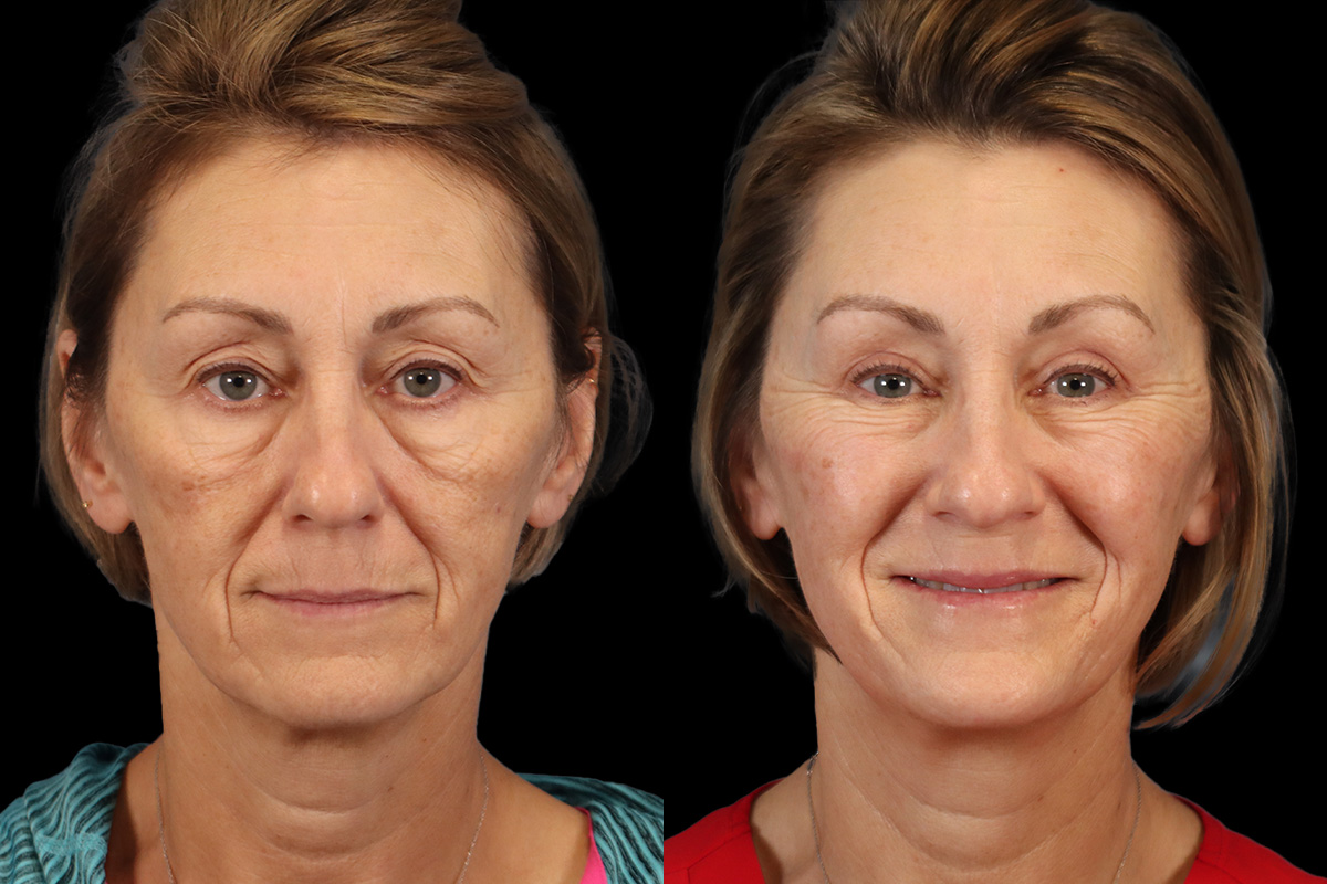 Blepharoplasty Before & After Gallery - Patient 147292 - Image 1