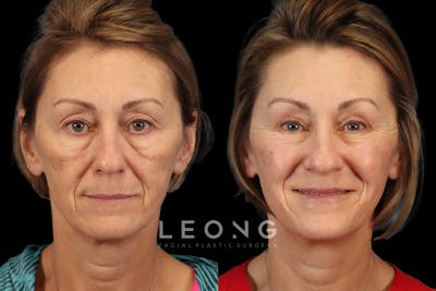 Eyes Before & After Gallery - Patient 155949 - Image 1