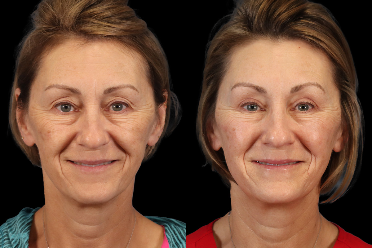 Eyes Before & After Gallery - Patient 155949 - Image 3