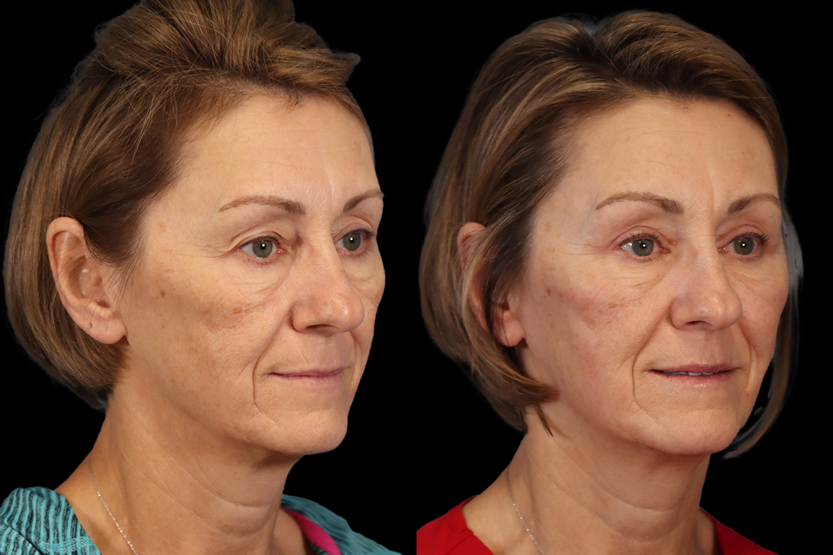 Eyes Before & After Gallery - Patient 155949 - Image 4