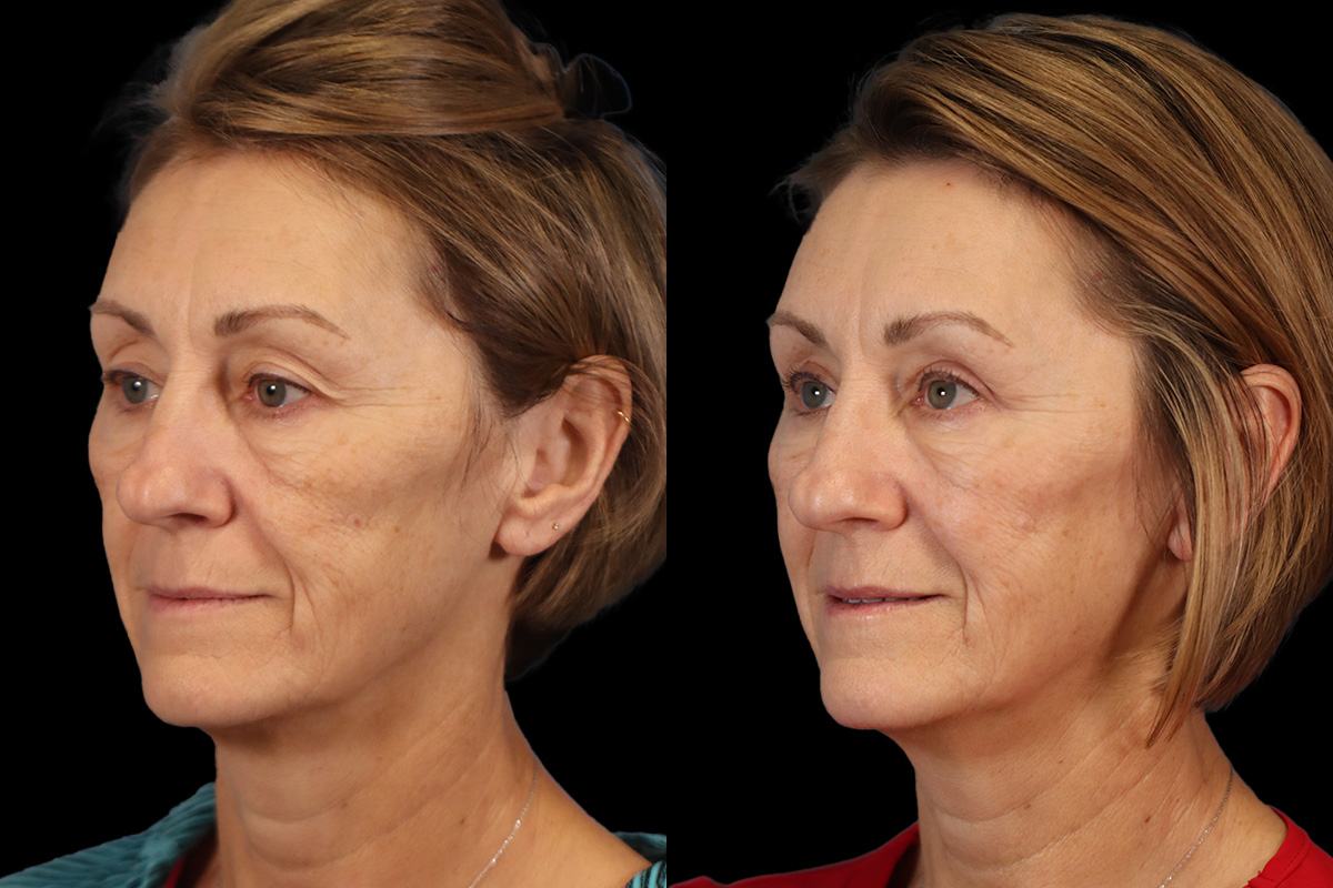 Eyes Before & After Gallery - Patient 155949 - Image 5