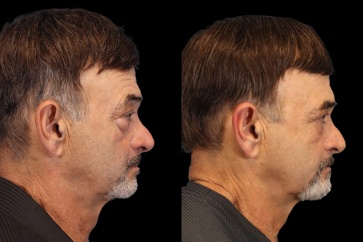 Eyes Before & After Gallery - Patient 586756 - Image 4