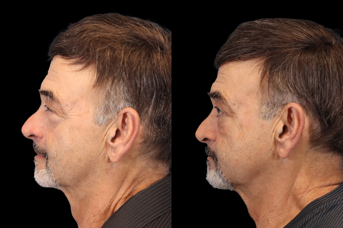 Eyes Before & After Gallery - Patient 586756 - Image 3