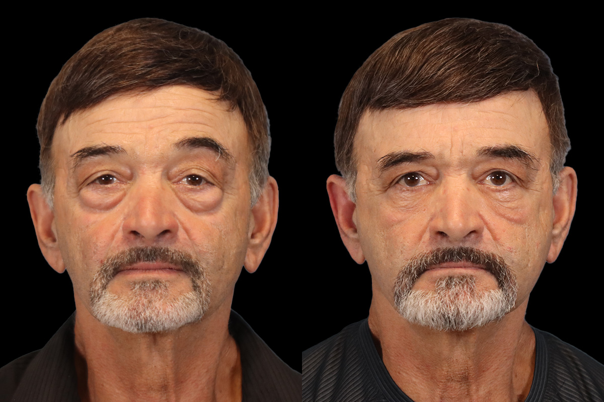 Blepharoplasty Before & After Gallery - Patient 203533 - Image 1