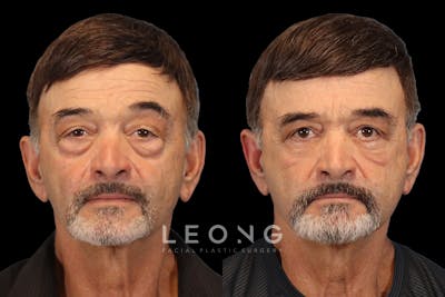 Eyes Before & After Gallery - Patient 586756 - Image 1