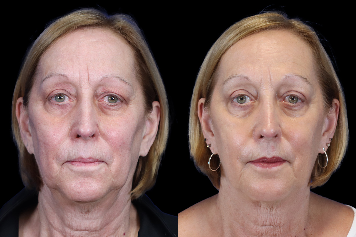 Blepharoplasty Before & After Gallery - Patient 225275 - Image 1