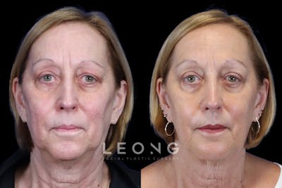 Eyes Before & After Gallery - Patient 227551 - Image 1