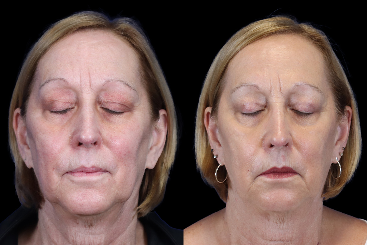 Eyes Before & After Gallery - Patient 227551 - Image 2