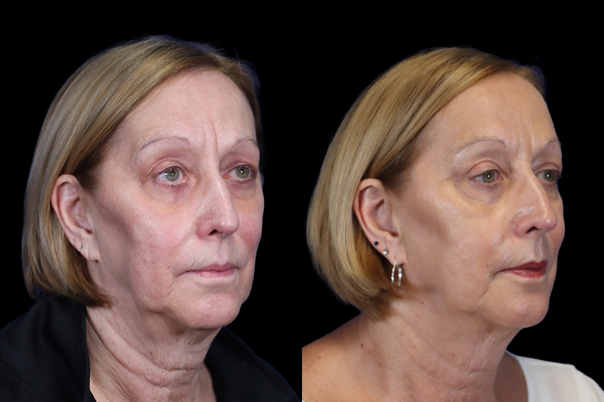 Eyes Before & After Gallery - Patient 227551 - Image 3