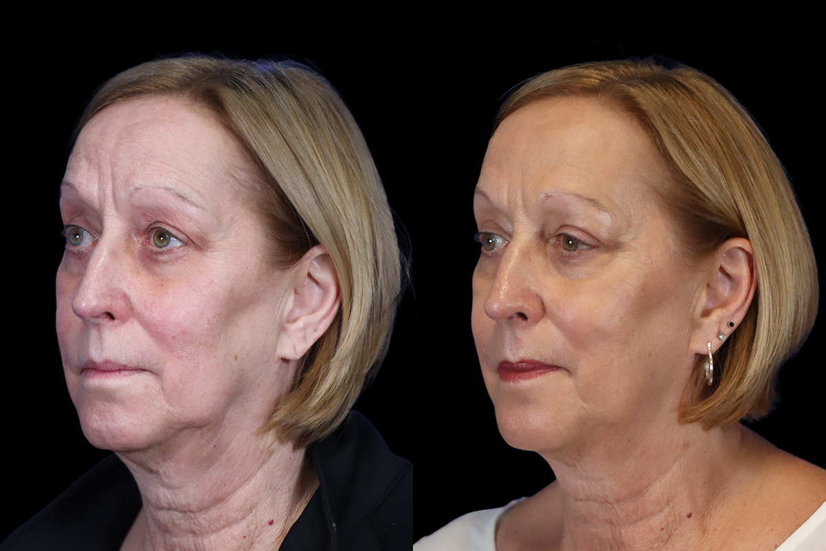 Eyes Before & After Gallery - Patient 227551 - Image 4