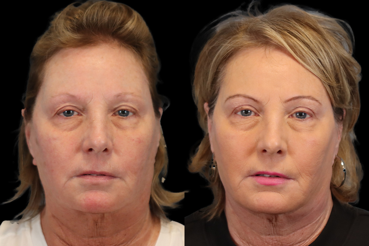 Blepharoplasty Before & After Gallery - Patient 264854 - Image 1