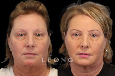 Eyes Before & After Gallery - Patient 205945 - Image 1