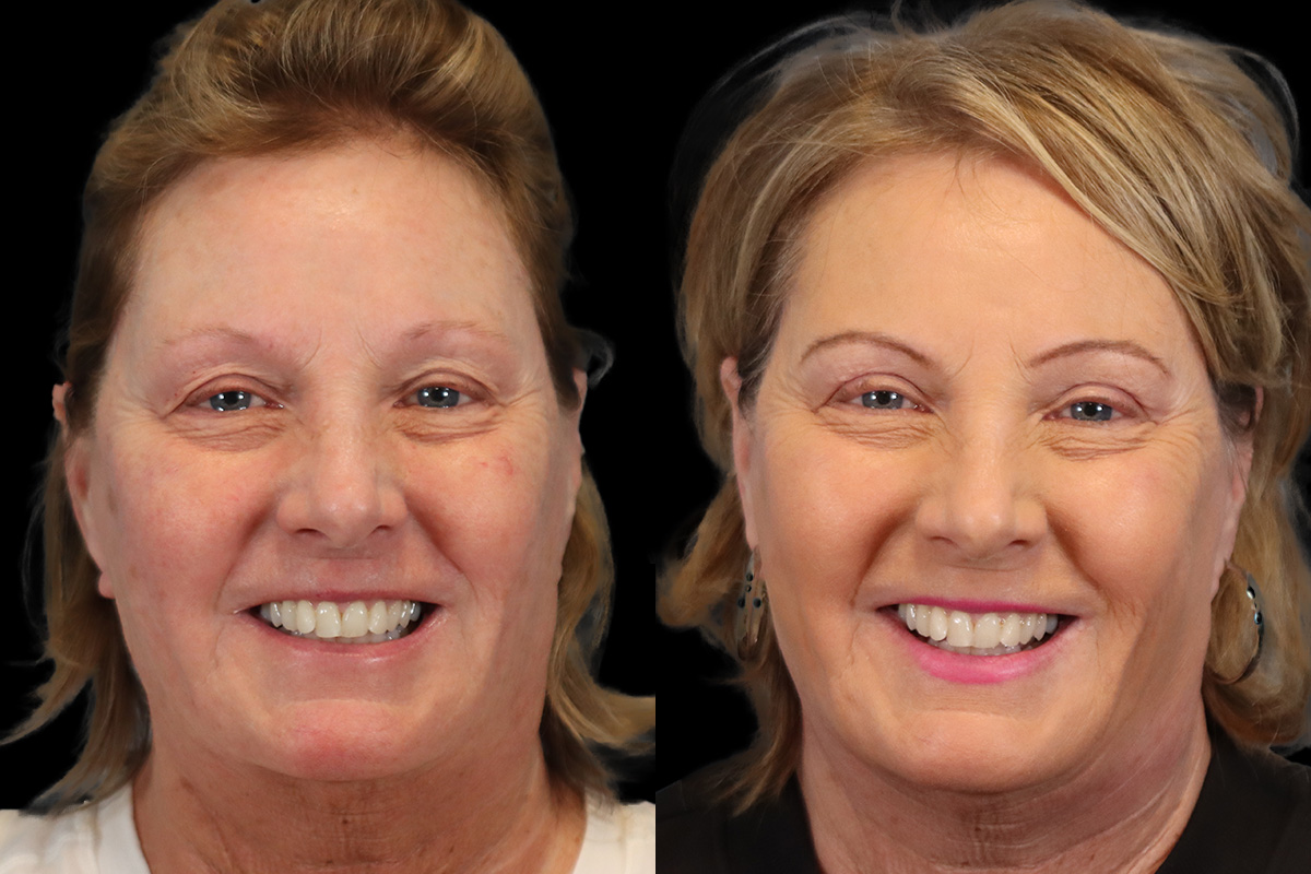 Eyes Before & After Gallery - Patient 205945 - Image 2