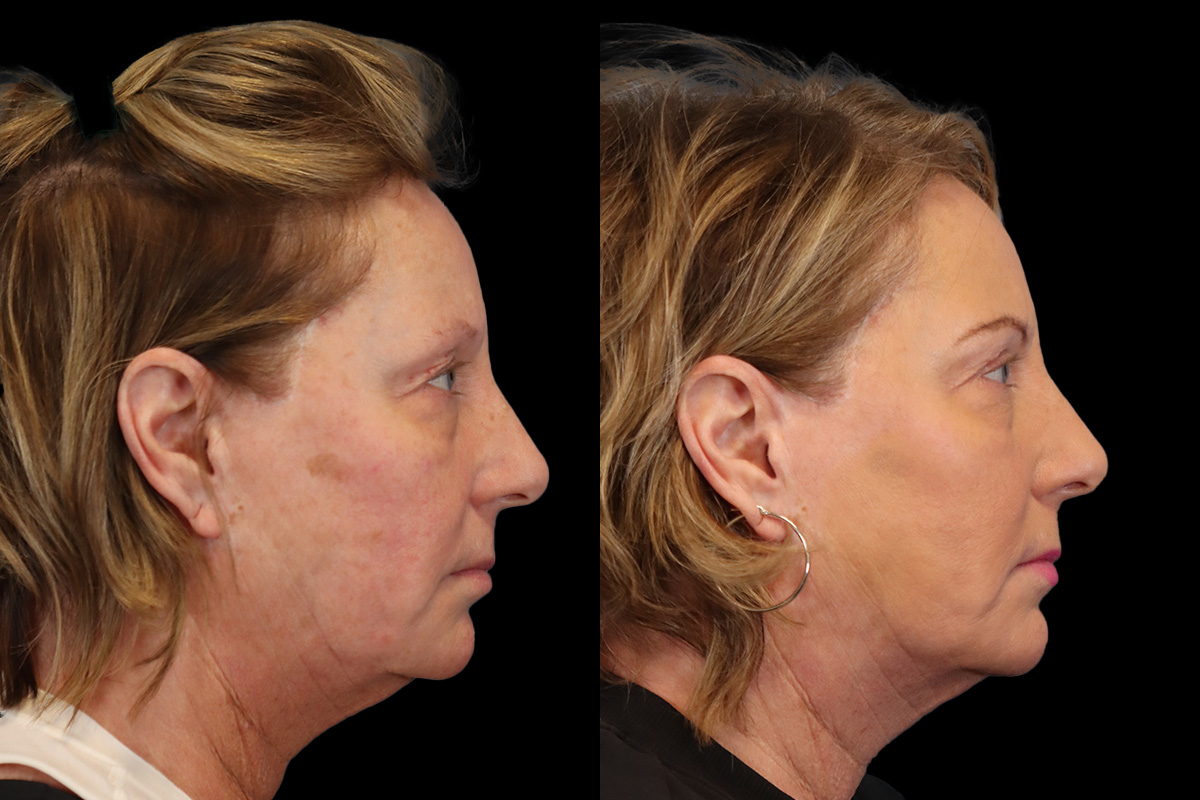 Eyes Before & After Gallery - Patient 205945 - Image 4