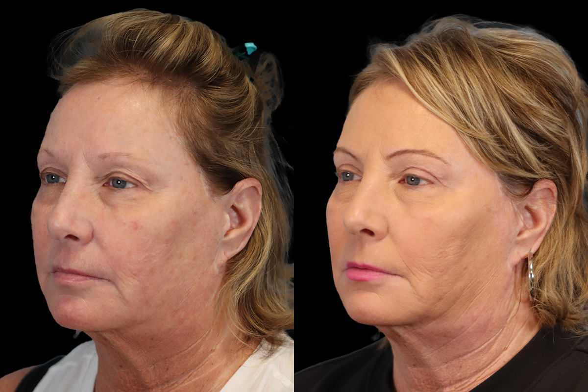 Eyes Before & After Gallery - Patient 205945 - Image 5