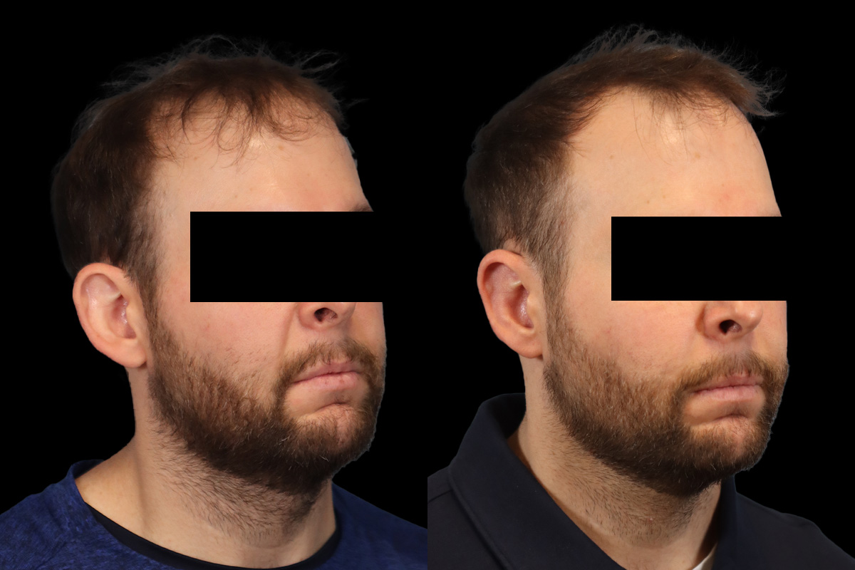 Otoplasty Before & After Gallery - Patient 277822 - Image 2