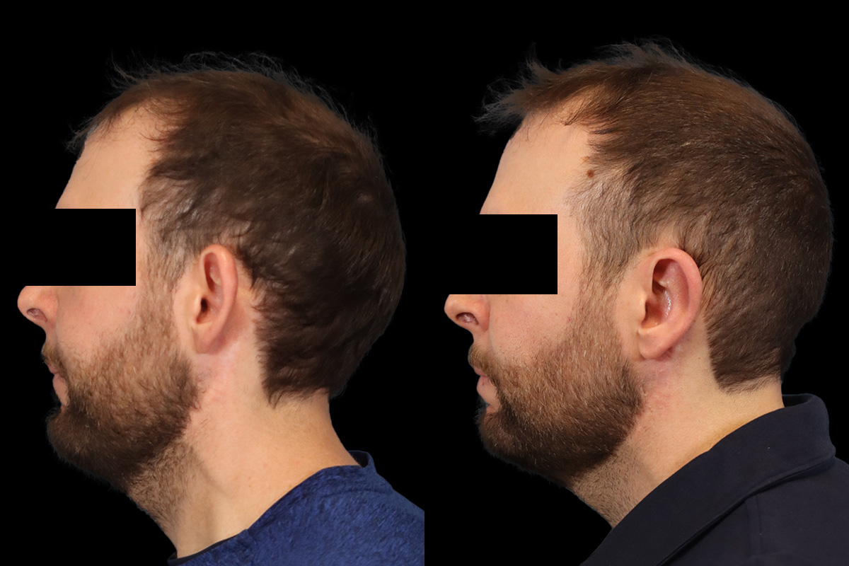 Otoplasty Before & After Gallery - Patient 277822 - Image 5