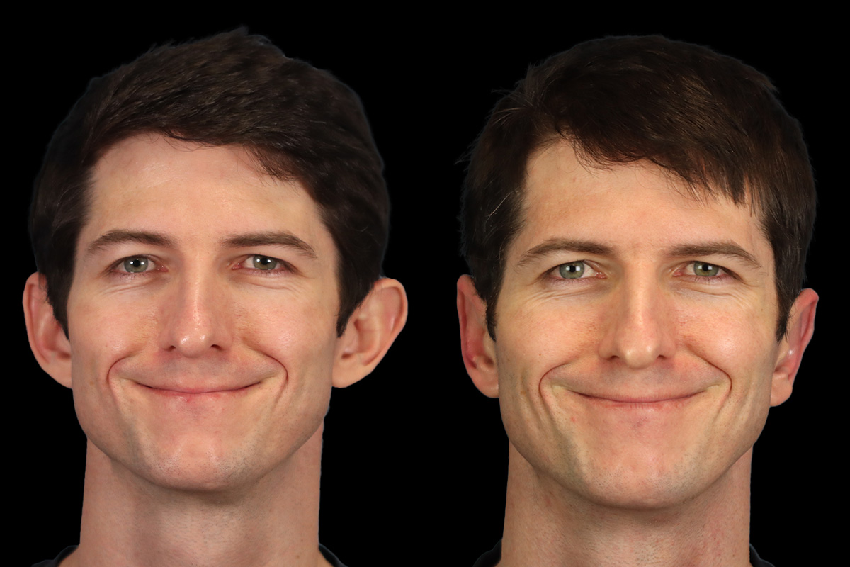 Otoplasty Before & After Gallery - Patient 323085 - Image 2