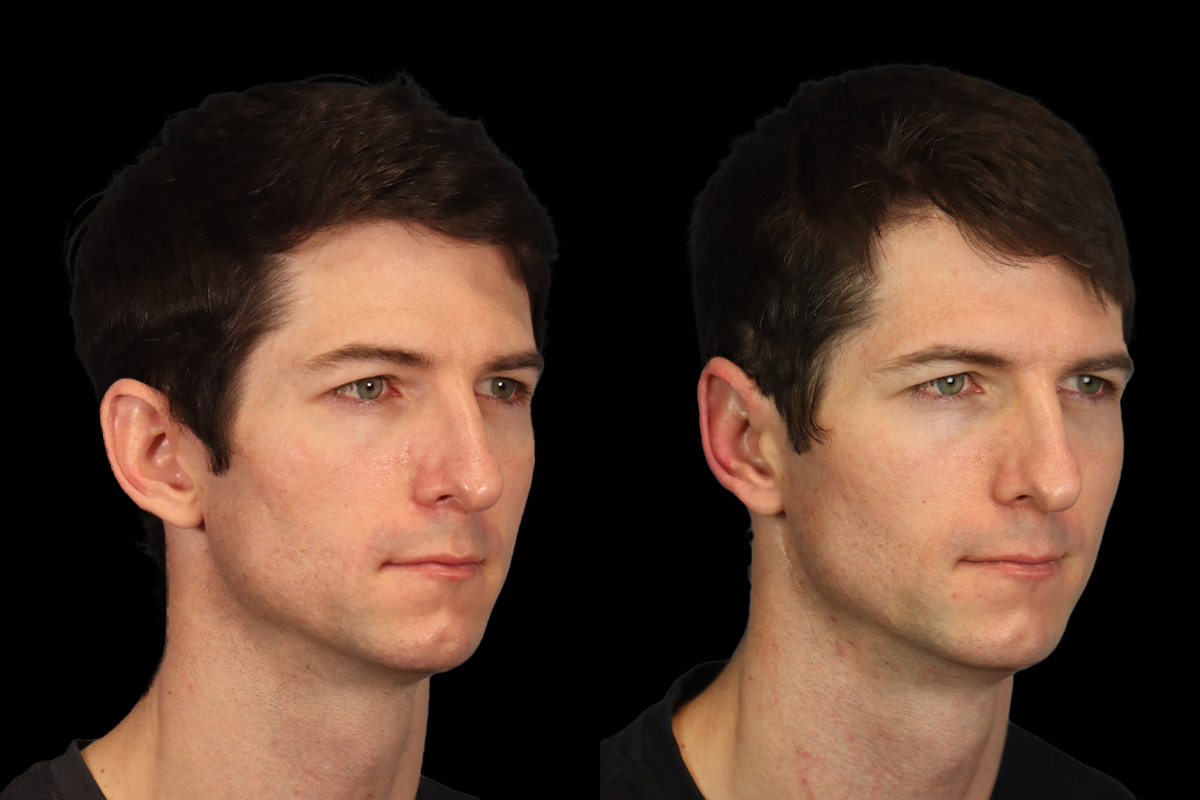 Otoplasty Before & After Gallery - Patient 323085 - Image 3