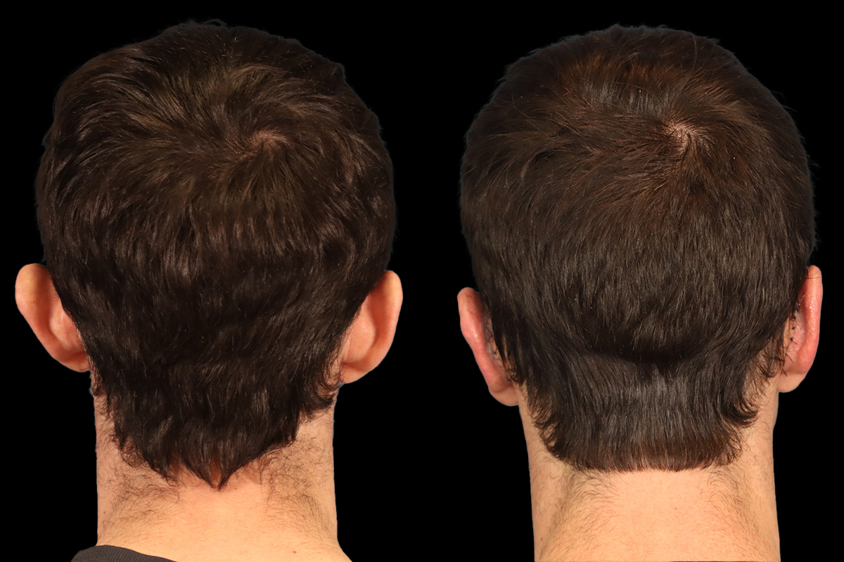 Otoplasty Before & After Gallery - Patient 323085 - Image 5