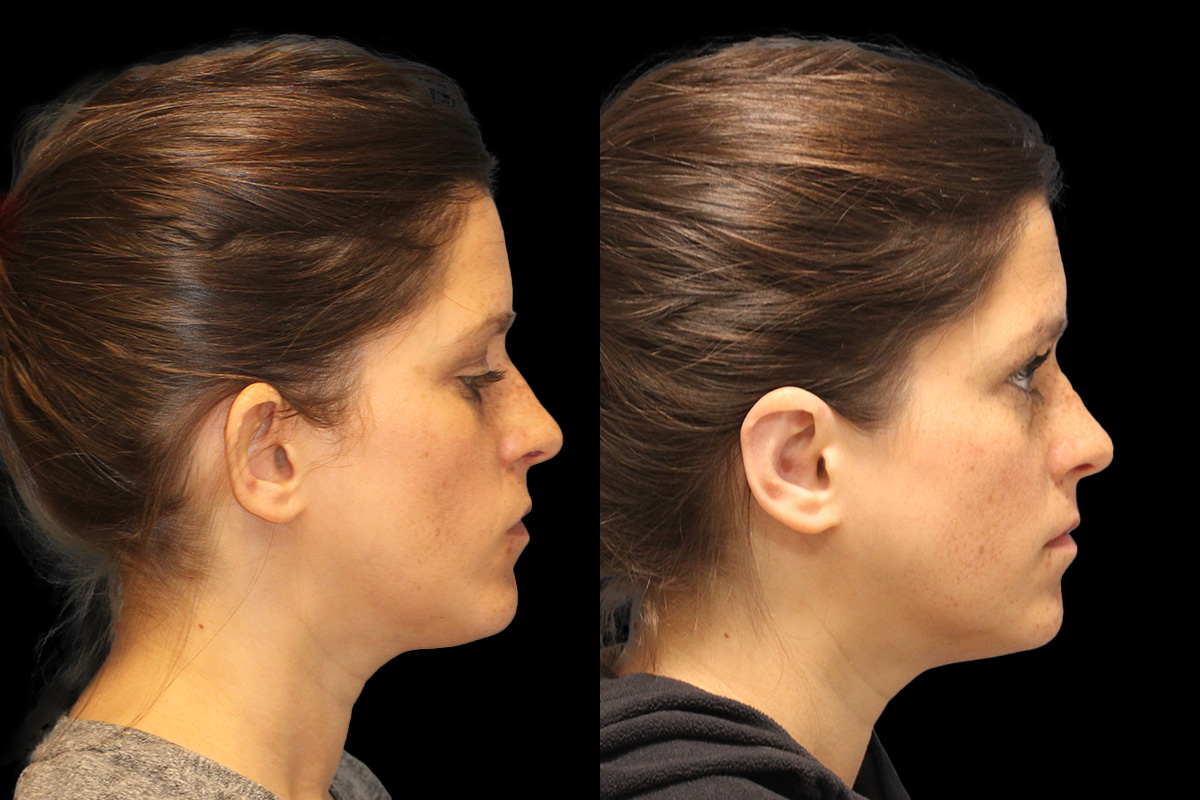 Otoplasty Before & After Gallery - Patient 168575 - Image 2