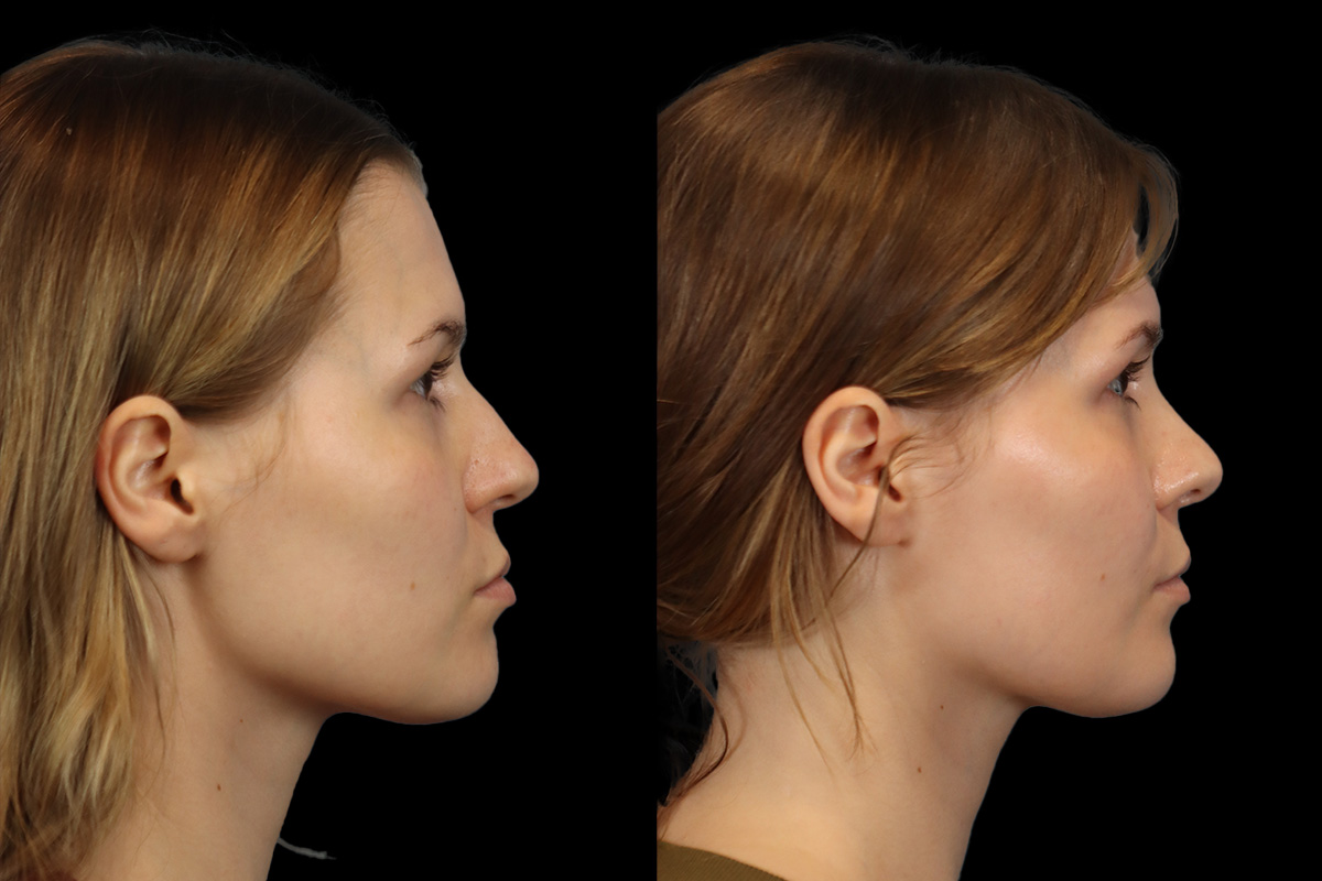 Rhinoplasty Before & After Gallery - Patient 237611 - Image 4