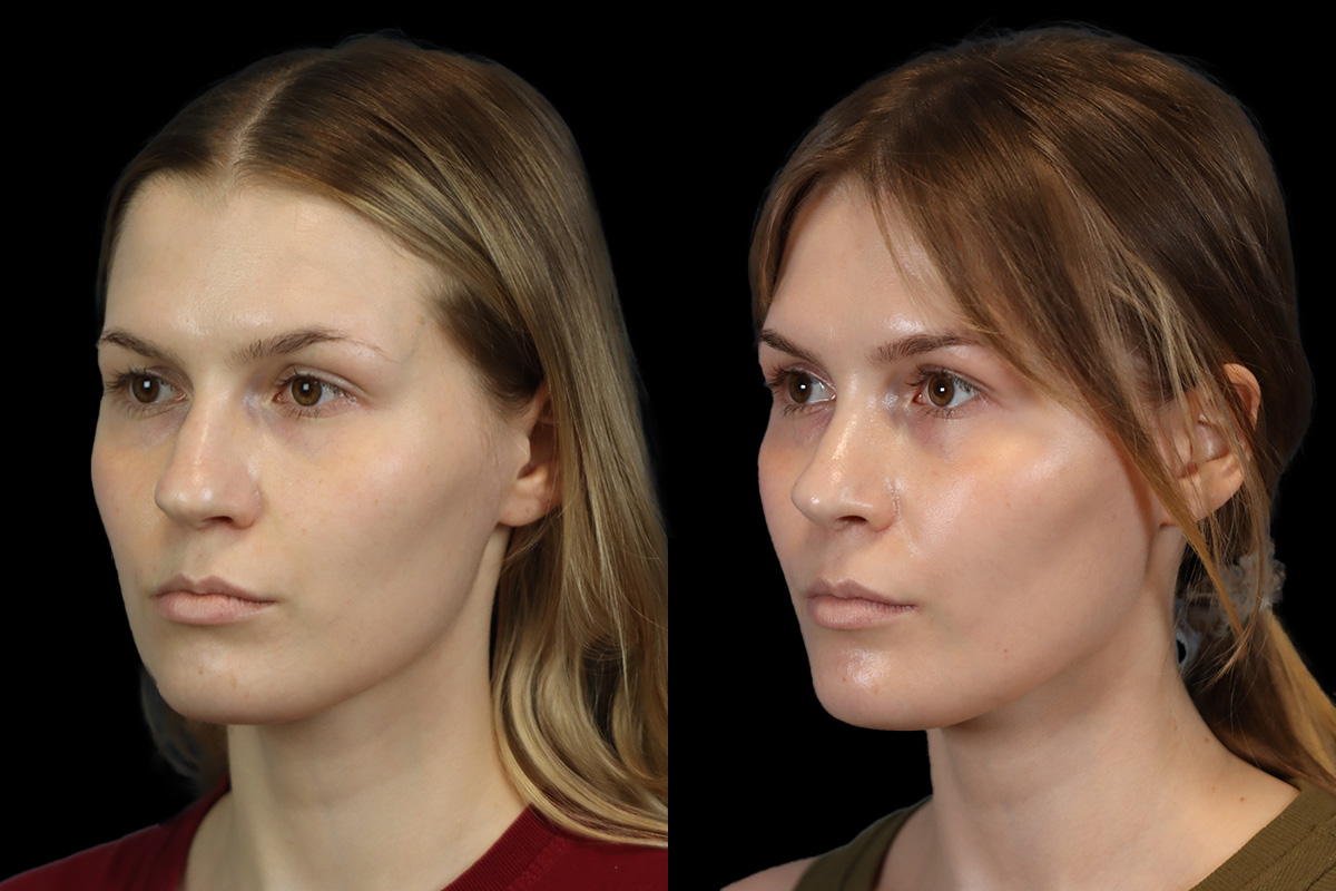 Rhinoplasty Before & After Gallery - Patient 237611 - Image 6