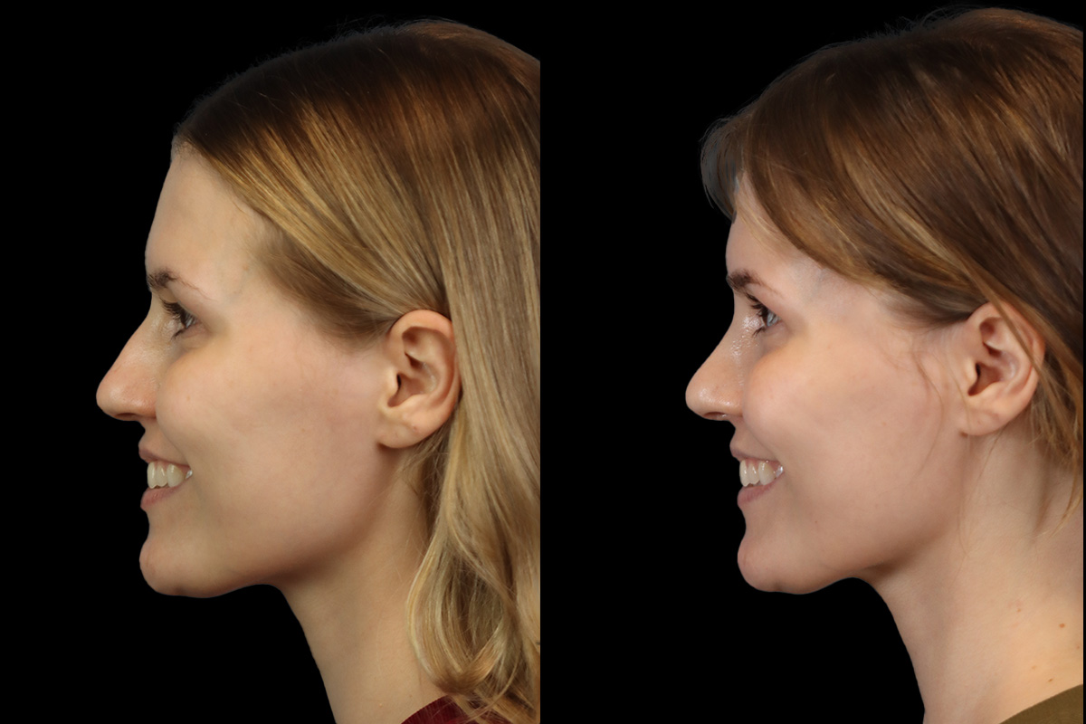 Rhinoplasty Before & After Gallery - Patient 237611 - Image 8