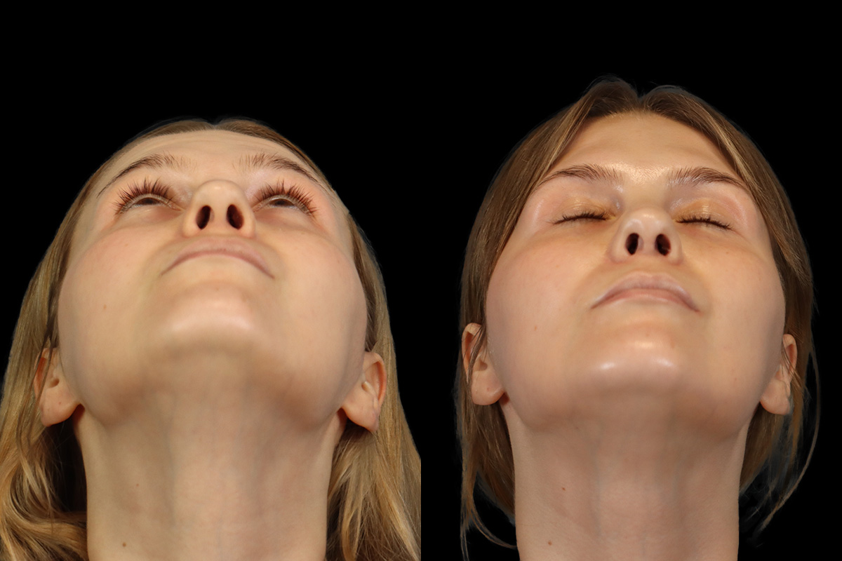 Rhinoplasty Before & After Gallery - Patient 237611 - Image 9