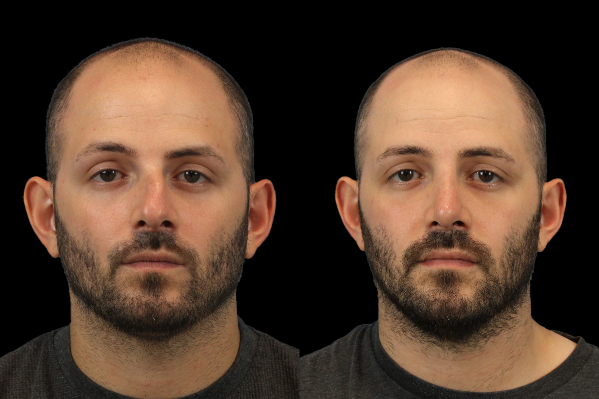 Nose Before & After Gallery - Patient 360671 - Image 1