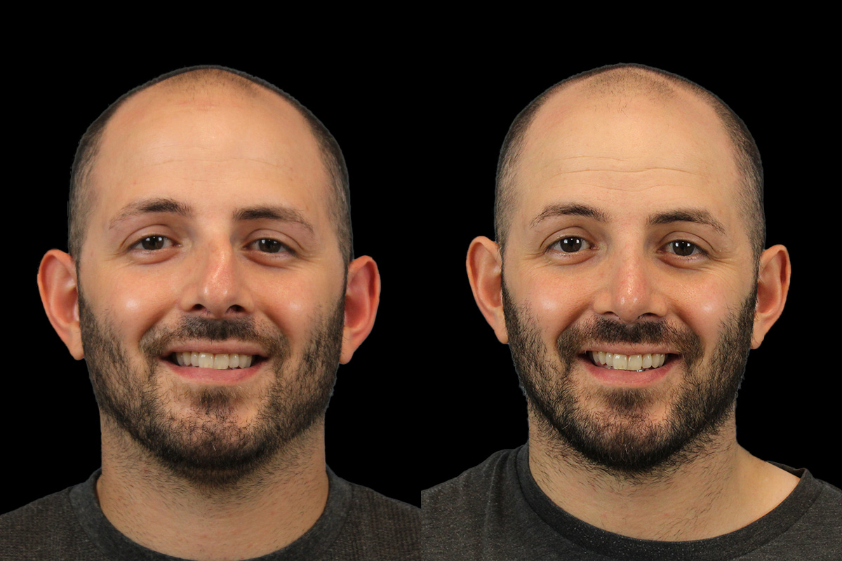 Rhinoplasty Before & After Gallery - Patient 101021 - Image 2