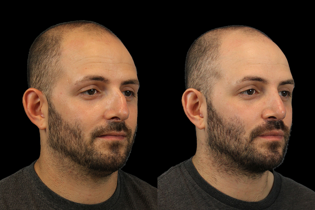 Rhinoplasty Before & After Gallery - Patient 101021 - Image 3