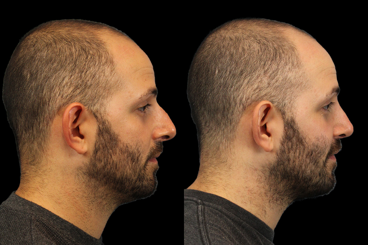 Rhinoplasty Before & After Gallery - Patient 101021 - Image 4