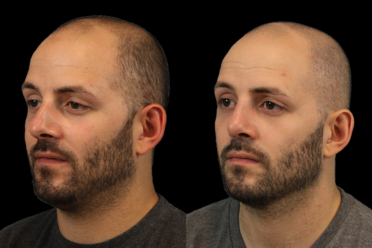 Rhinoplasty Before & After Gallery - Patient 101021 - Image 6