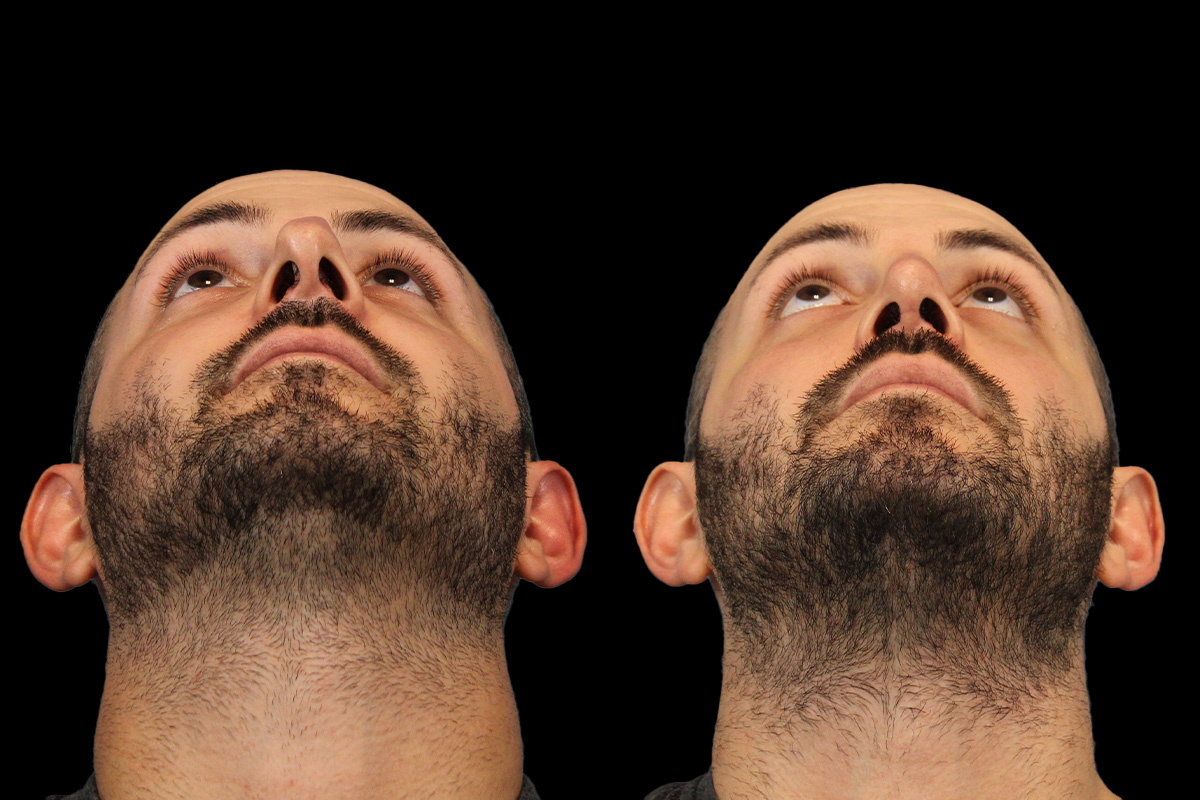 Rhinoplasty Before & After Gallery - Patient 101021 - Image 9