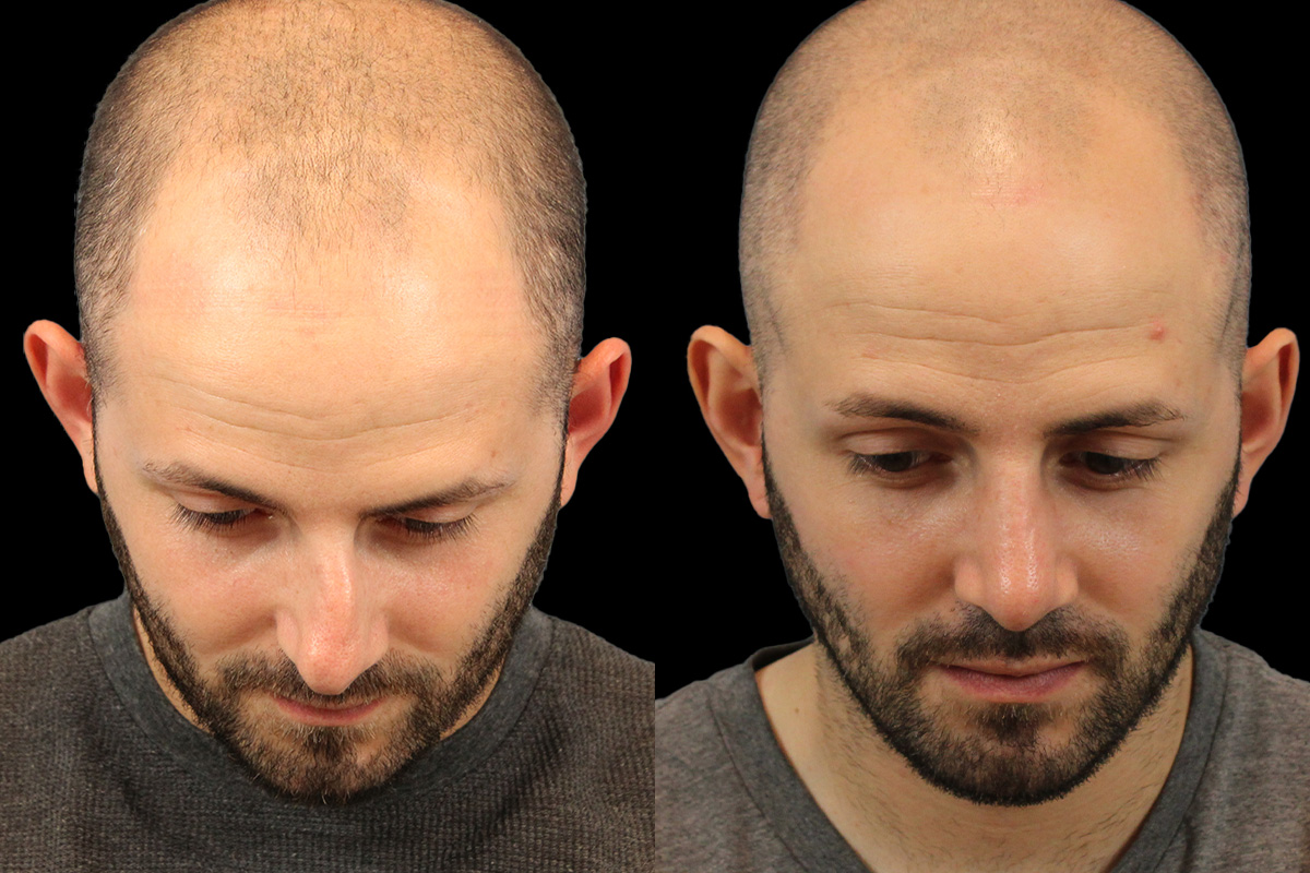 Rhinoplasty Before & After Gallery - Patient 101021 - Image 10