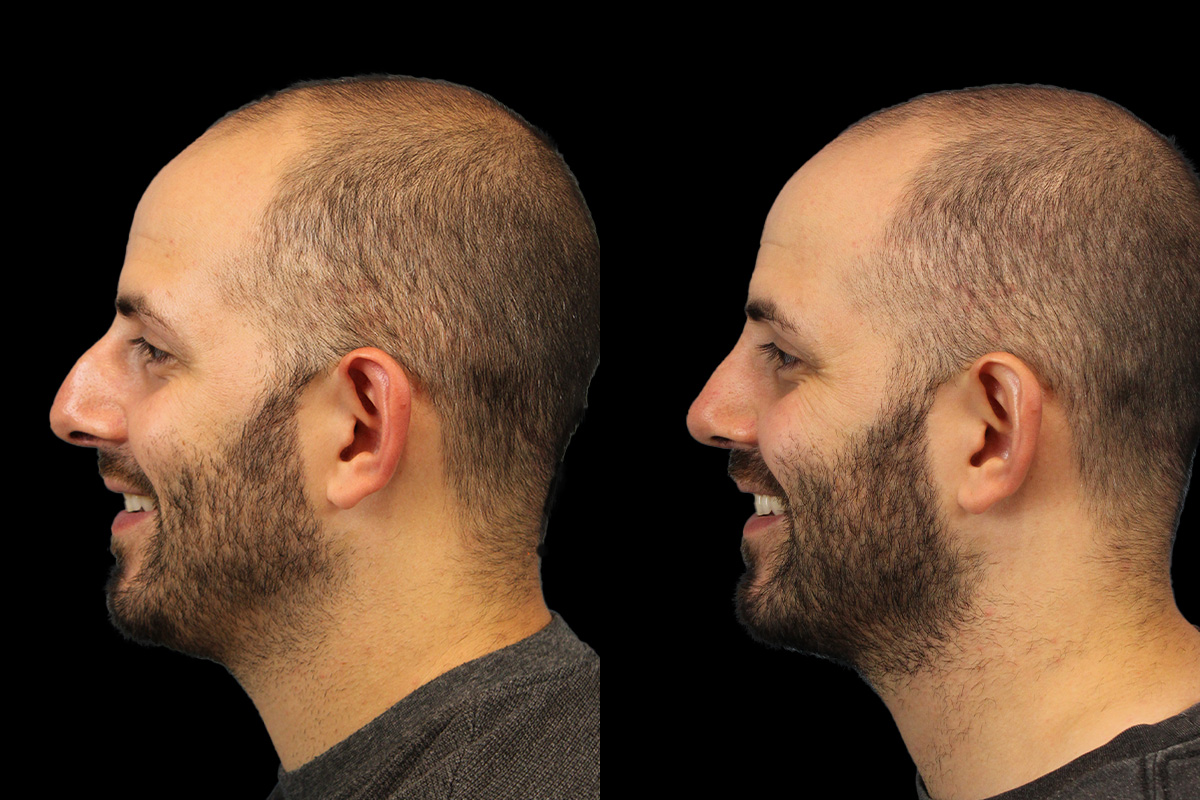 Rhinoplasty Before & After Gallery - Patient 101021 - Image 8